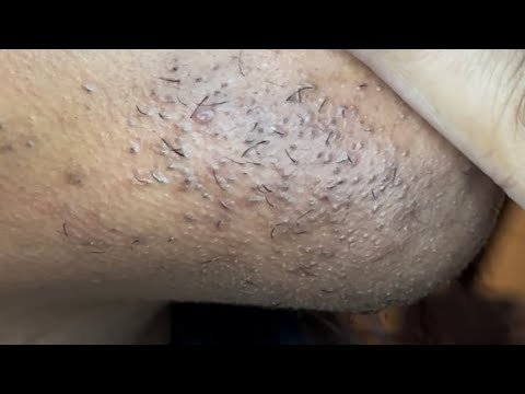 INGROWN HAIR REMOVAL #139 - KP222 Luxury Twee...