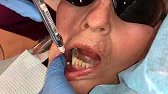 Mental-Incisive Nerve Block