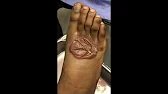 POPPING BLISTER / SKIN BURNS
