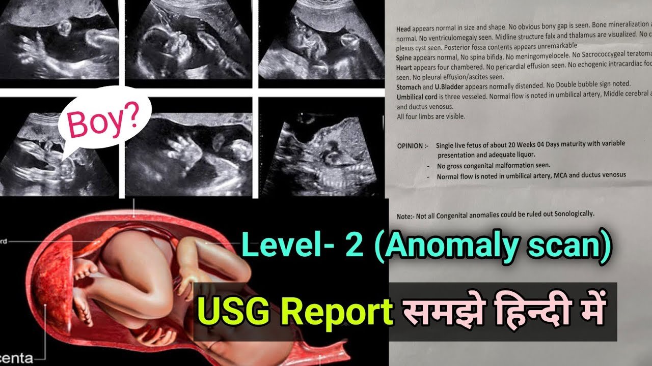 FWB Ultrasound Report Level 2/ Anomaly Scan, Level 2 Ultrasound Report समझे हिन्दी में USG Report