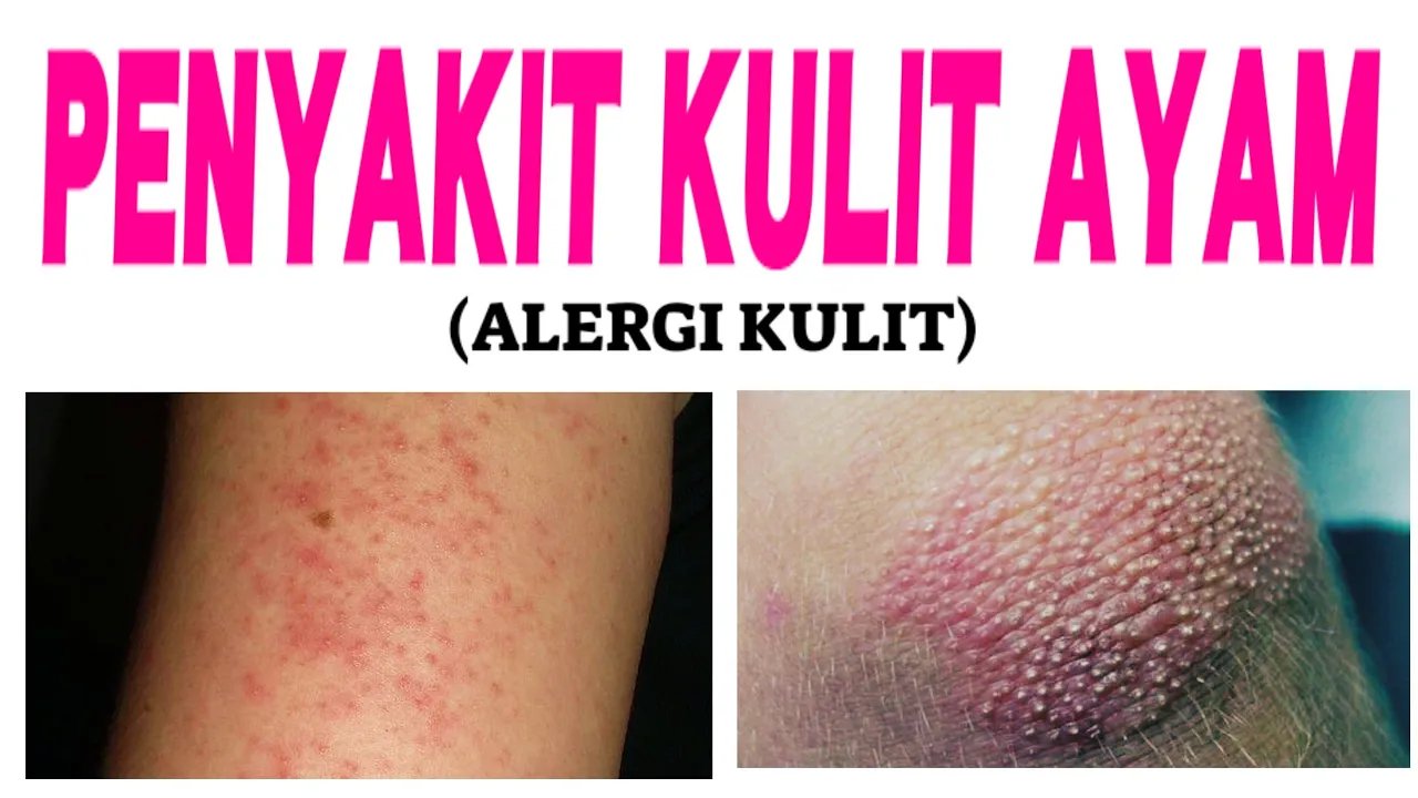 Keratosis Pilaris (Penyakit Kulit Ayam) - Gejala, Penyebab, dan Pengobatan || Hydrocotisone Krim