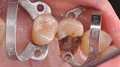 Saving a broken down tooth with rct and crown.