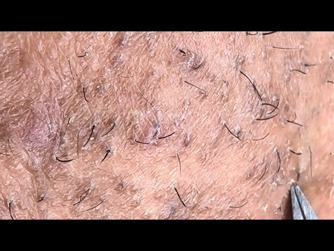 INGROWN HAIR REMOVAL #151 - Best Plucking Vid...