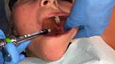 Inferior Alveolar and Lingual Nerve Blocks